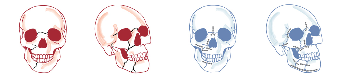 Facial Trauma Reconstruction