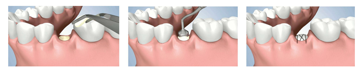 Bone grafting